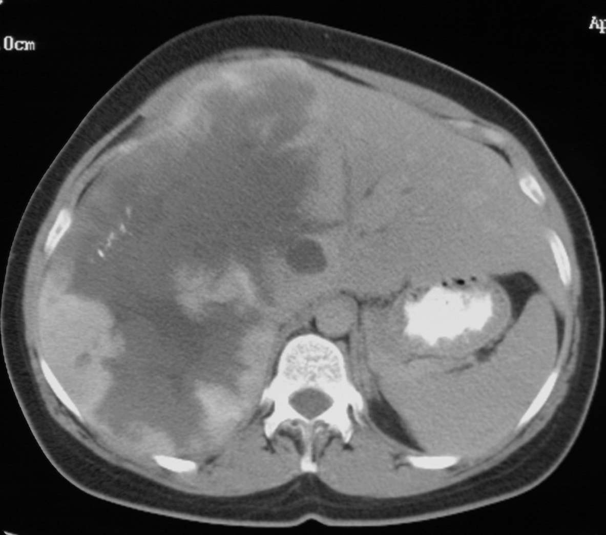 What liver lesion is this?