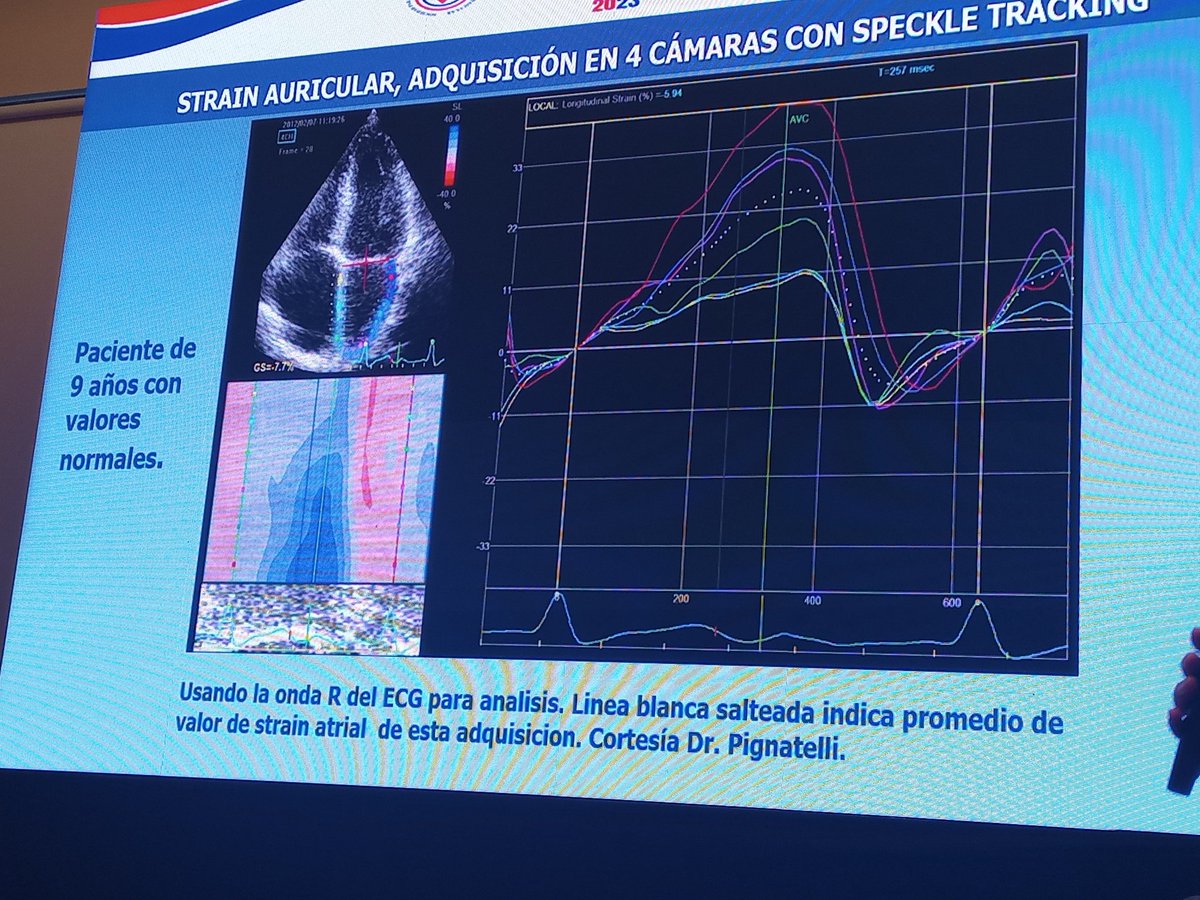 Estenosis pulmonar, miocardiopatia hipertifica <a href="/SISIACOficial/">SISIAC</a>