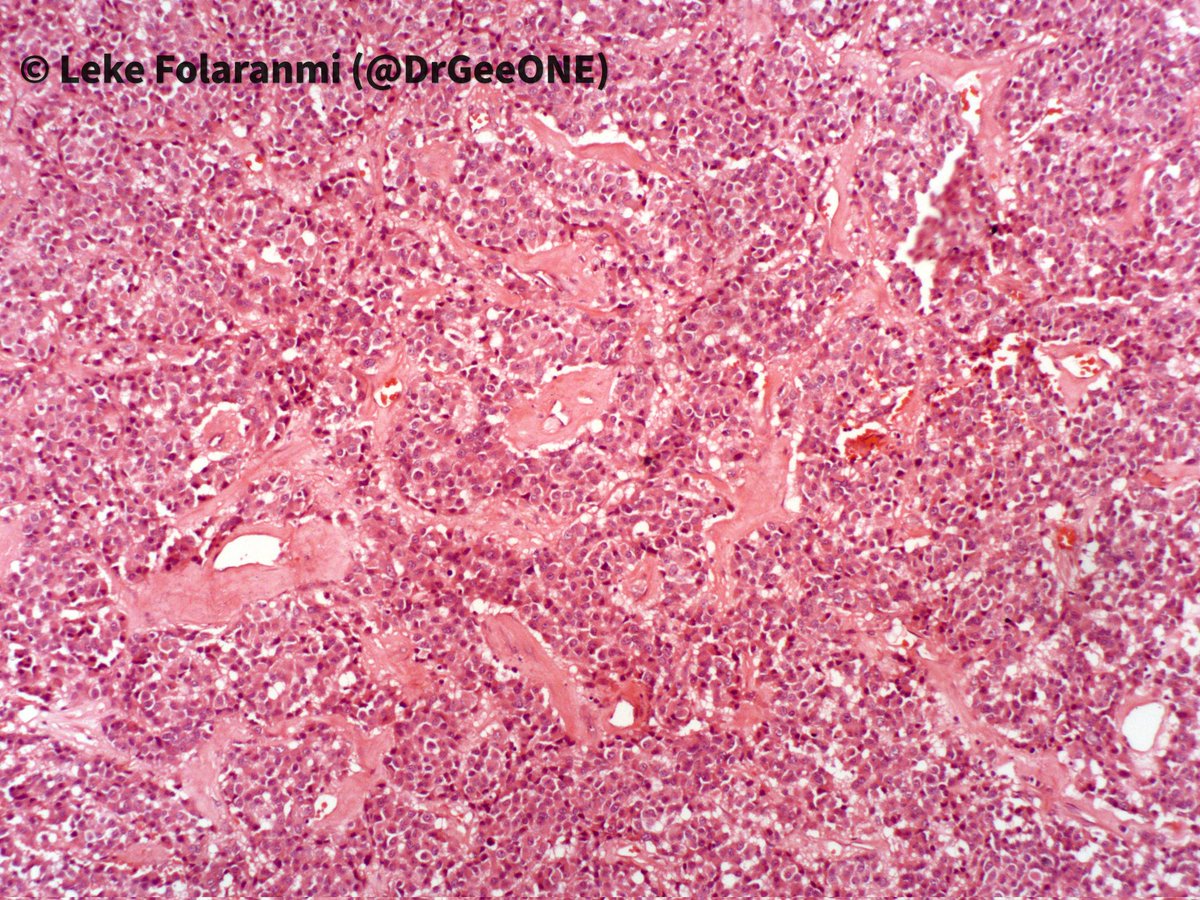 DrGeeONE's tweet image. Kindly share your thoughts on this:
Late 30s, About 4 years of recurring headache and worsening vision bilaterally.
👨🏾‍⚕️🔪-Well encapsulated huge suprasellar mass ?Pituitary macroadenoma 
No access to IHCs.
#CNSPath #Neuropath #Endopath
#Pathology