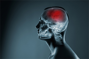 How To File Your Wernicke’s Encephalopathy or Korsakoff’s Syndrome Brain Damage Lawsuit
yourlawyer.com/wernickes-ence…