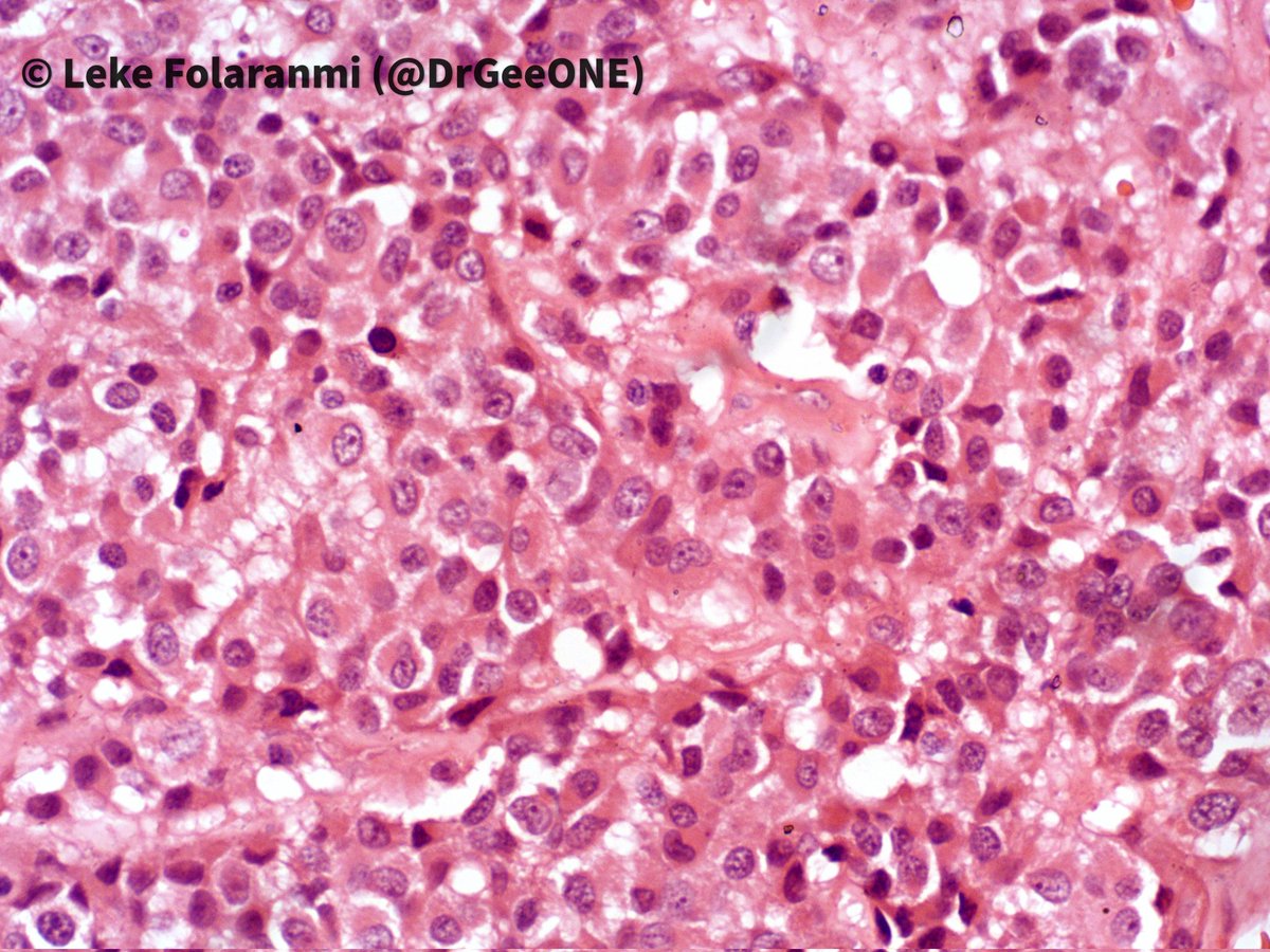 DrGeeONE's tweet image. Kindly share your thoughts on this:
Late 30s, About 4 years of recurring headache and worsening vision bilaterally.
👨🏾‍⚕️🔪-Well encapsulated huge suprasellar mass ?Pituitary macroadenoma 
No access to IHCs.
#CNSPath #Neuropath #Endopath
#Pathology