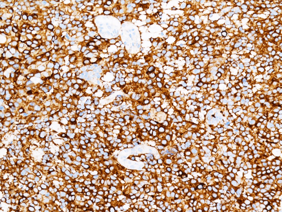 jfhang's tweet photo. 67 y/o male presented with epigastric pain for 4 mos and was found with a pancreatic head mass. EUS-guided FNA and bx show solid aggregates of epithelioid tumor cells with easily striped nuclei. Bcl-10 strongly pos. Dx: Acinar cell carcinoma. 
#cytopath #FNA #GIpath #PathTwitter https://t.co/gFYnIdfYTr