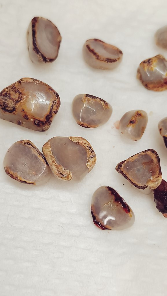 Shiney, pearly gallstones from  gb with adenocarcinoma.  First time seeing such polished stones!