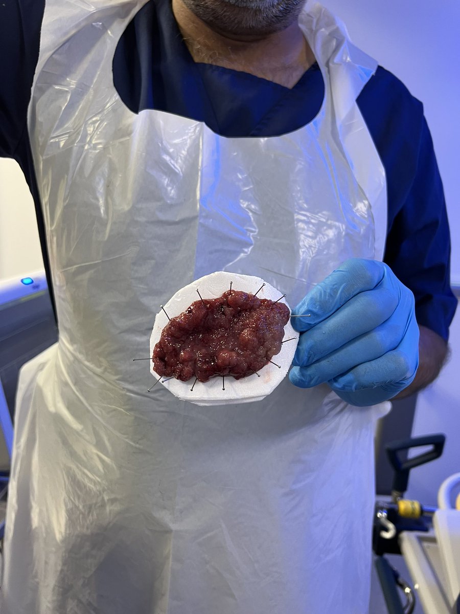 Sajjad Mahmood (@smkahlon) on Twitter photo A marathon case without patient sedation at UHA.
A master at his art S Ahmed.
Great work S Ahmed and J Iqbal @javaidxiqbal <a href="/rizsaleem/">Rizwan Saleem</a> <a href="/sterndrnick/">Nick Stern</a> <a href="/pawanlekharaju/">Venkata Pawan Kumar</a> <a href="/WythEndo/">WythenshaweEndoscopyMFT</a> A marathon case without patient sedation at UHA.
A master at his art S Ahmed.
Great work S Ahmed and J Iqbal @javaidxiqbal <a href="/rizsaleem/">Rizwan Saleem</a> <a href="/sterndrnick/">Nick Stern</a> <a href="/pawanlekharaju/">Venkata Pawan Kumar</a> <a href="/WythEndo/">WythenshaweEndoscopyMFT</a>