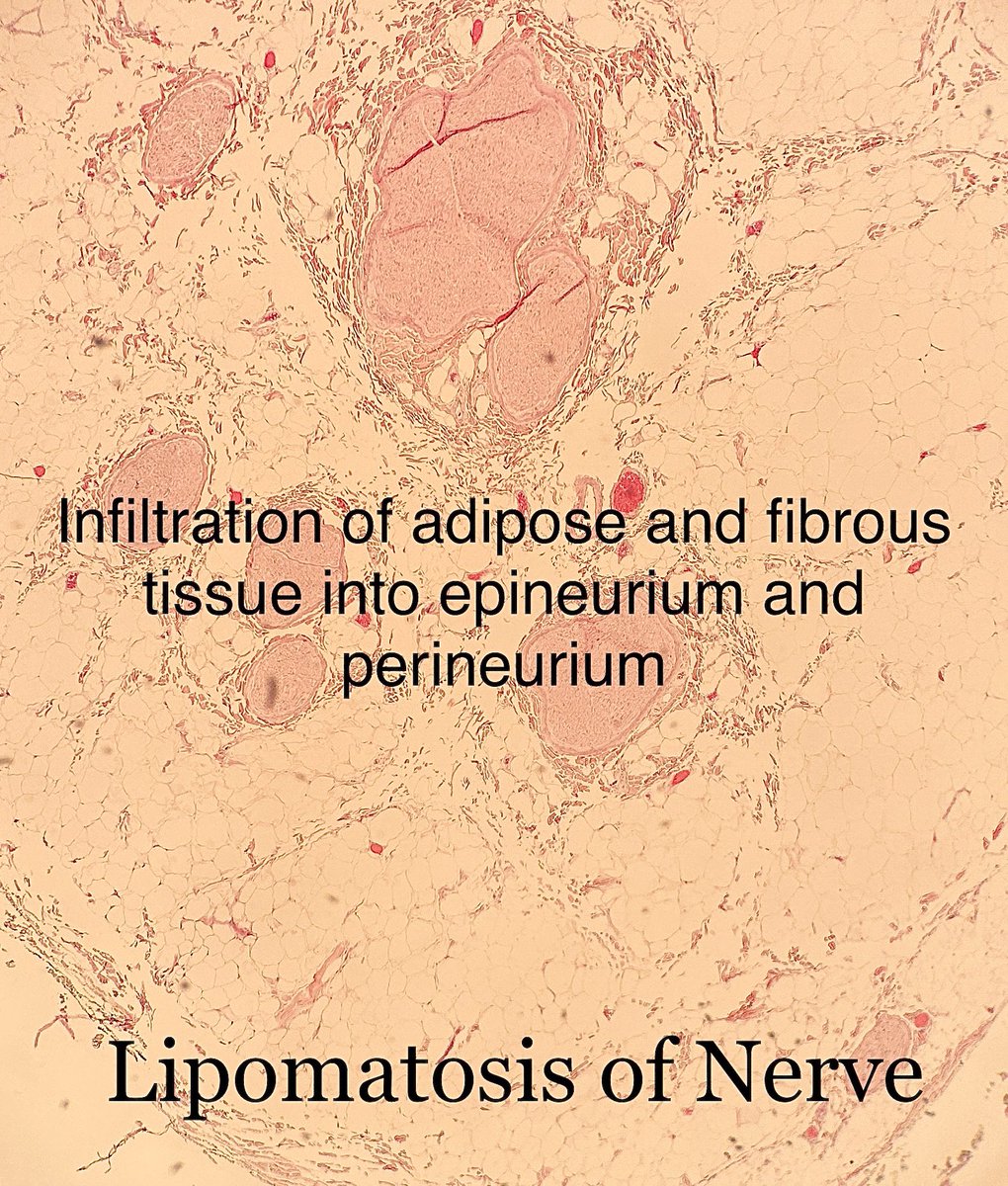 Lipomatosis of Nerve;

Usually happens in younger adults < 30

Location — generally median nerve and its branches

Benign but surgery may be difficult to do due to nerve involvement.

#pathagonia #softtissue #orthohand #ortho #orthox #surgx #gensurg