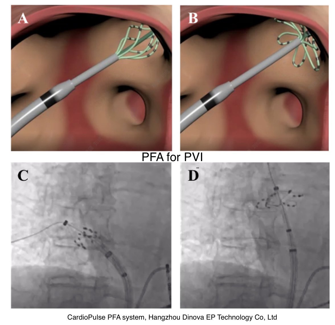 ShaojieChen1's tweet photo. ⚡️ a Novel Device for simultaneous PFA of LAA Isolation and LAAO 
after PFA based PVI

surprise or not?

Tang et al @JACCJournals 

cited https://t.co/hp0KkhAbRT

@JGrapsa @dredcronin @ftrae @CRB_EP @drrakeshg1 @EJSMD @drjohnm @SchakrabartiEP @DrMarwanRefaat @javadm20 @pjsm83 @mencardio @shemybenchetrit @glckty @gabustillosg @berniann @ugurcanpolatmd @manuelpatete @liviateixeiramd @ACuevaParra @mspartalis5 @KTamirisaMD @yolyabreuh @DrRoderickTung 
@Maeskander @jaymontgomery44 @drgastonvergara @gautamsand @EugenioCingolan @Hapa_EP @FYang_EP @DaviddlCuevas @wedenskyeffect @CSHeartResearch 
@Innov_Medicine @APHRSOfficial 
@C_Meyer_MD @Phiso_de @Dominik_Linz @RolandTilz @purerfellner