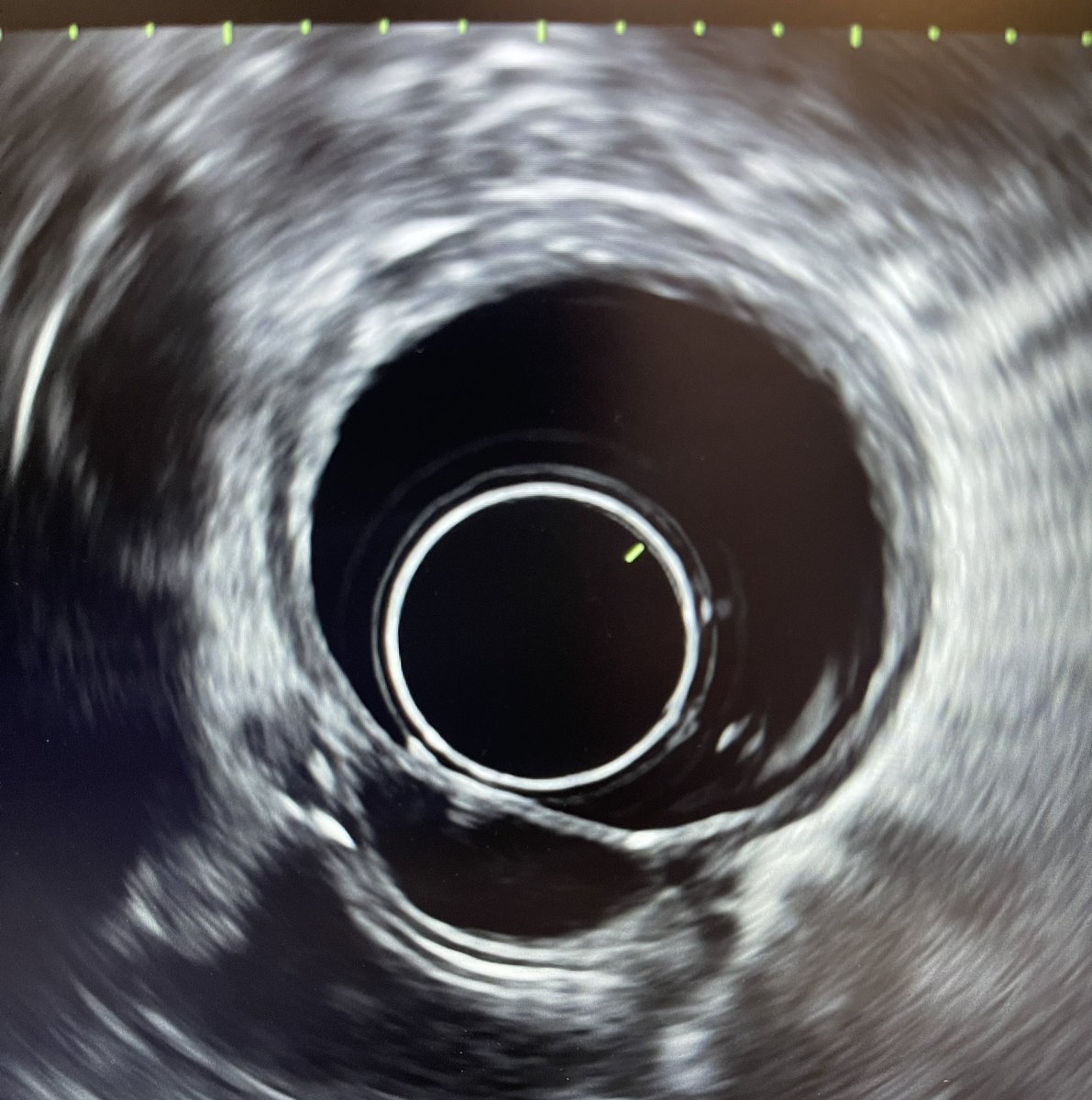 MarijoRojasMD's tweet photo. Patient referred for esophageal subepithelial lesion - this is one of the few instances FNA shouldn’t be performed- neg Doppler anechoic = Duplication Cyst . Quiste de duplicación en esófago- anecoico no necesita FNA #GI #gastro #GITwitter #MedTwitter #EUS #esofago #teach https://t.co/3W38aAkgMc