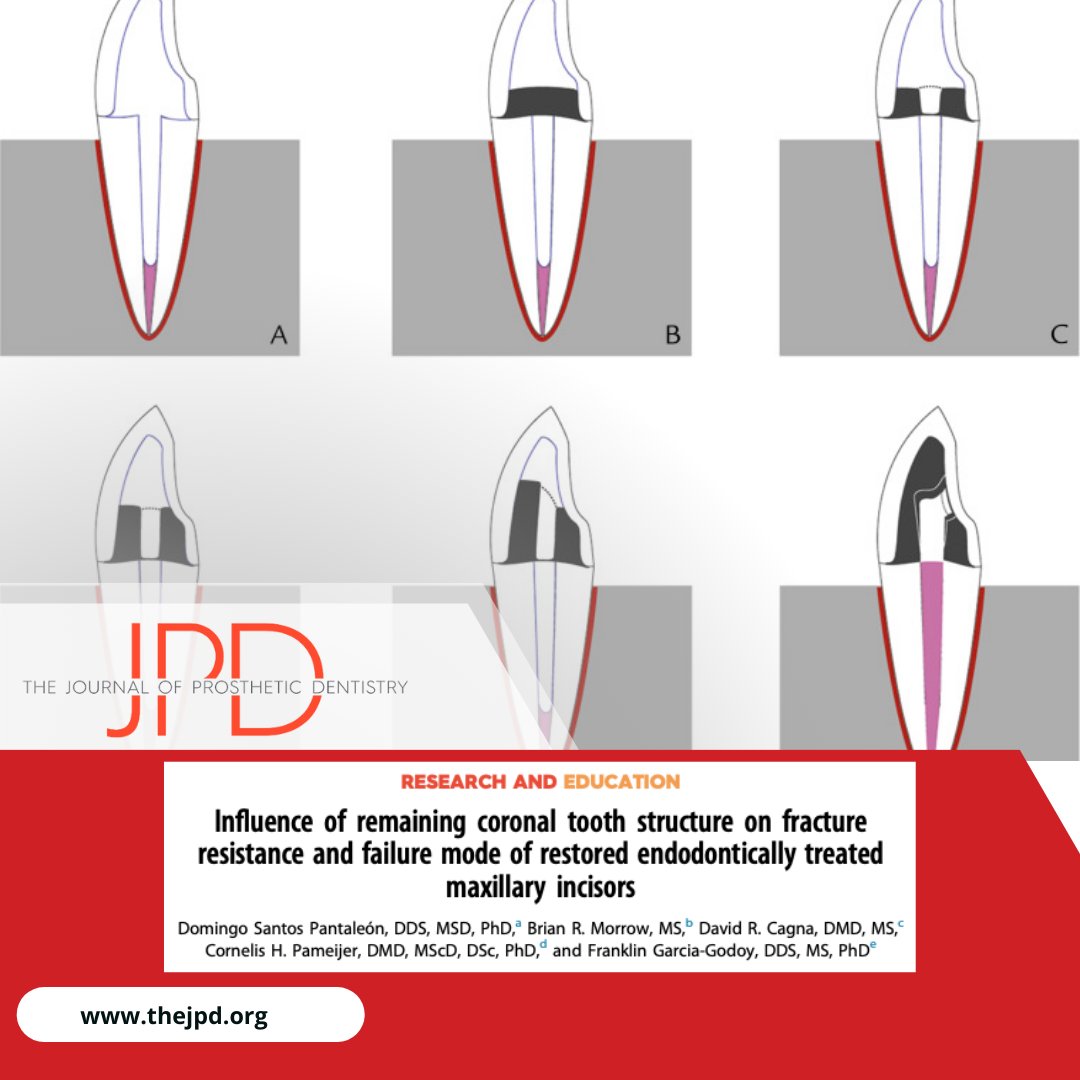JPDentistry's tweet image. #tooth preservation is affected by the prosthetic design. Learn more about how the height and location of #ferrule in an #anteriortooth with #rootcanaltherapy and metal #postandcore affects its structural durability and integrity: thejpd.org/article/S0022-…