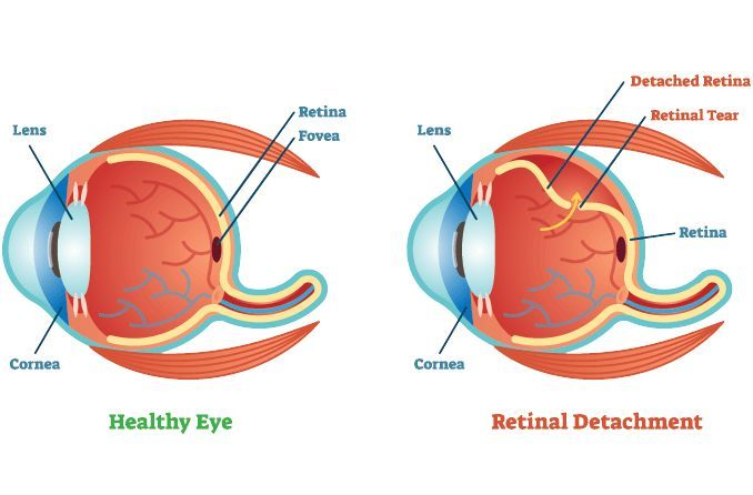 Retinal detachment describes an emergency situation in which a thin layer of tissue at the back of the eye pulls away from its normal position. 
Visit us: lnkd.in/drMgeUAW
Submit to: optometry@maplejournal.com
#eyehealth #eyeinfection #ophthalmology #retinaldetachment