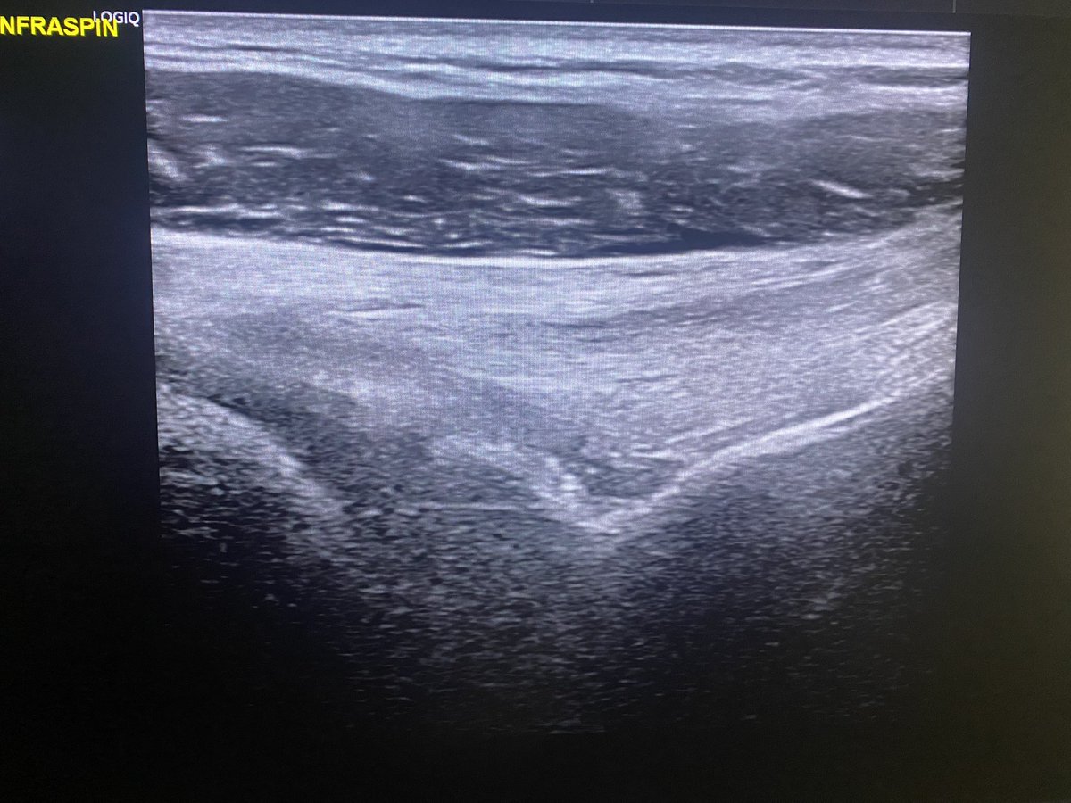 With consent. 46 y/o female. Insid onset severe scapular pain followed by marked sh weakness and scapulothoracic dyskinesia. US shows intact cuff but marked atrophy of infra and Supraspin mucles. Images show the contrast of this atrophy compared to overlying tapezius. Diagnosis ?