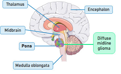 Our study on the role of BMP2 and BMP7 in pediatric diffuse midline gliomas H3.3K27M-mutated (#DMG #DIPG) has been accepted in <a href="/eLife/">eLife - the journal</a> !

Please look at this summary thread :-)

Link to the full paper: staging--epp.elifesciences.org/previews/91313…

1/25