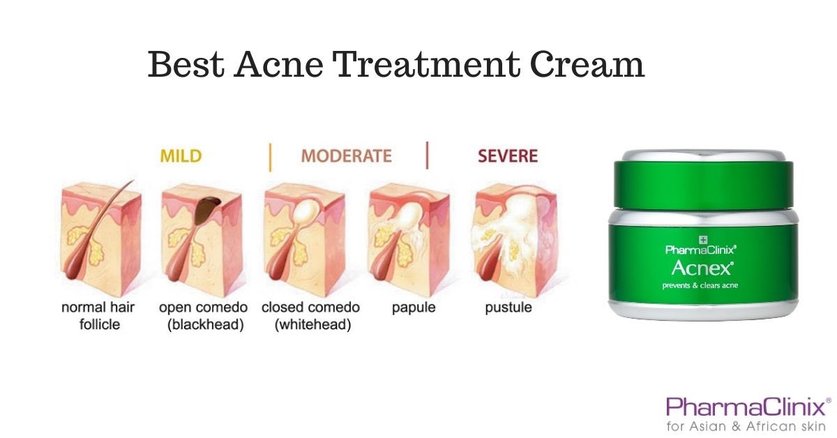 Acne Treatment Cream 
#acne