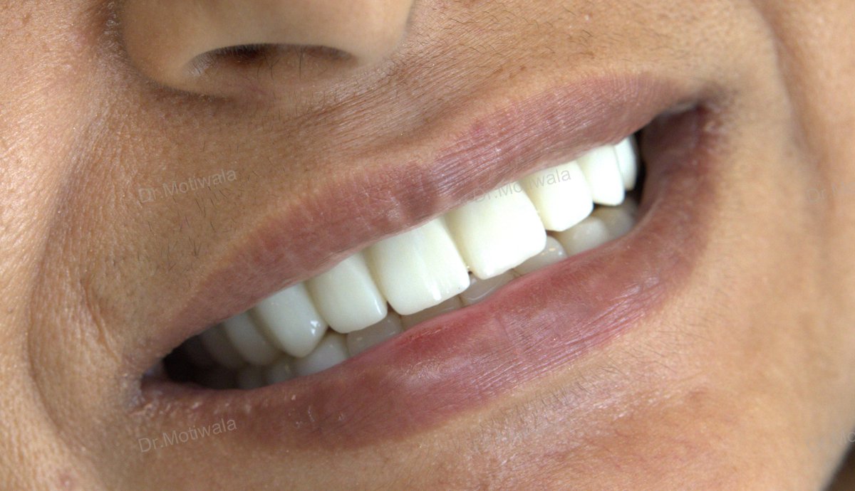 drmotiwaladcic's tweet image. Permanent teeth in 3 Days | Full Mouth Dental Implants in India  Single visit dentistry refers to the practice of completing dental treatments in just one appointment.  
#Zirconiacrowns #basalimplants #dentalimplants #fixedteethin3days drmotiwala.com #Hyderabad #india