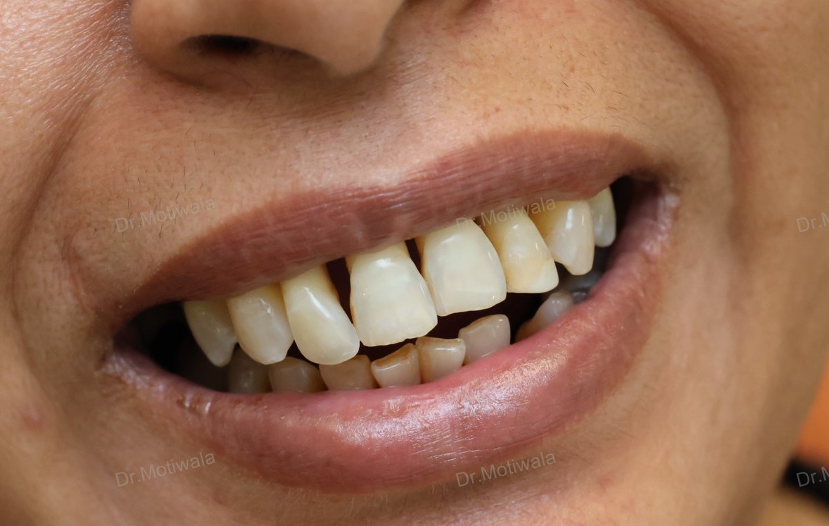 drmotiwaladcic's tweet image. Permanent teeth in 3 Days | Full Mouth Dental Implants in India  Single visit dentistry refers to the practice of completing dental treatments in just one appointment.  
#Zirconiacrowns #basalimplants #dentalimplants #fixedteethin3days drmotiwala.com #Hyderabad #india