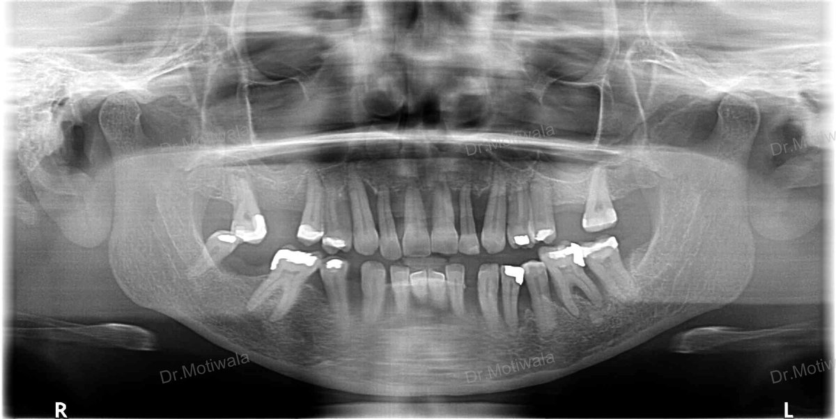 drmotiwaladcic's tweet image. Permanent teeth in 3 Days | Full Mouth Dental Implants in India  Single visit dentistry refers to the practice of completing dental treatments in just one appointment.  
#Zirconiacrowns #basalimplants #dentalimplants #fixedteethin3days drmotiwala.com #Hyderabad #india