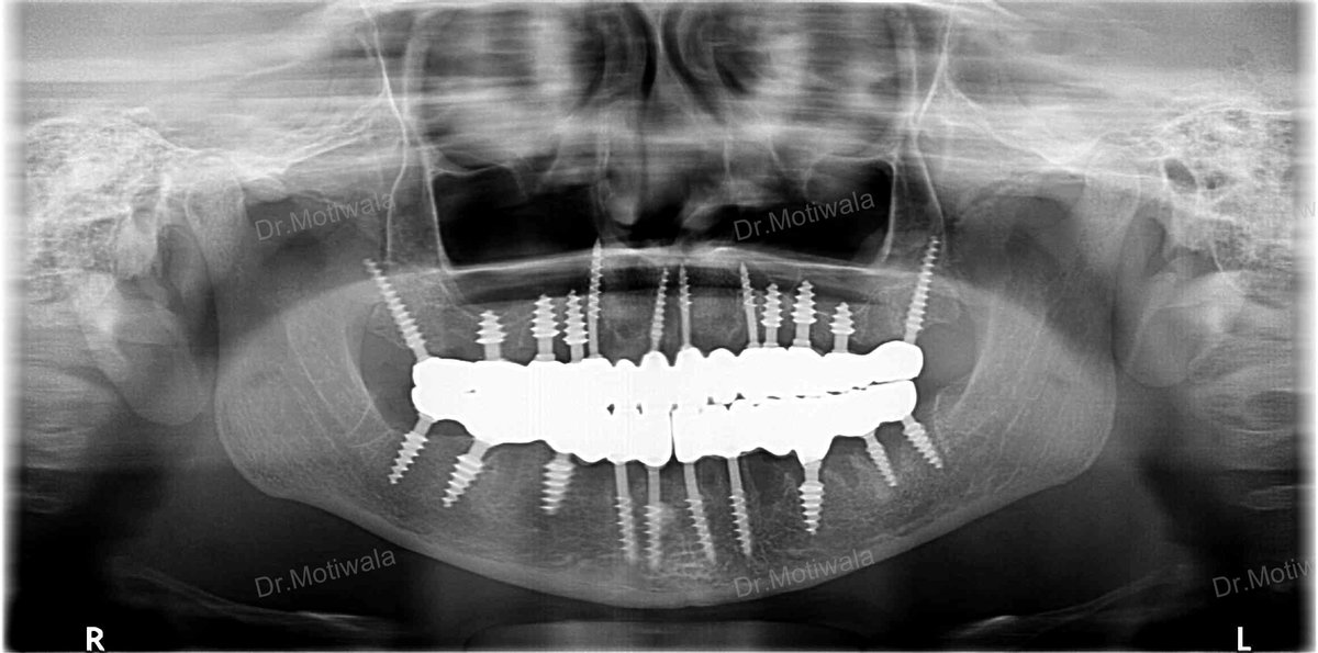 drmotiwaladcic's tweet image. Permanent teeth in 3 Days | Full Mouth Dental Implants in India  Single visit dentistry refers to the practice of completing dental treatments in just one appointment.  
#Zirconiacrowns #basalimplants #dentalimplants #fixedteethin3days drmotiwala.com #Hyderabad #india