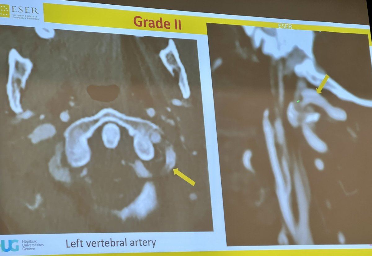 Dr. Alexandra Platon #BCVI rare, but serious vascular injury #ESER2023 @ESERadiology