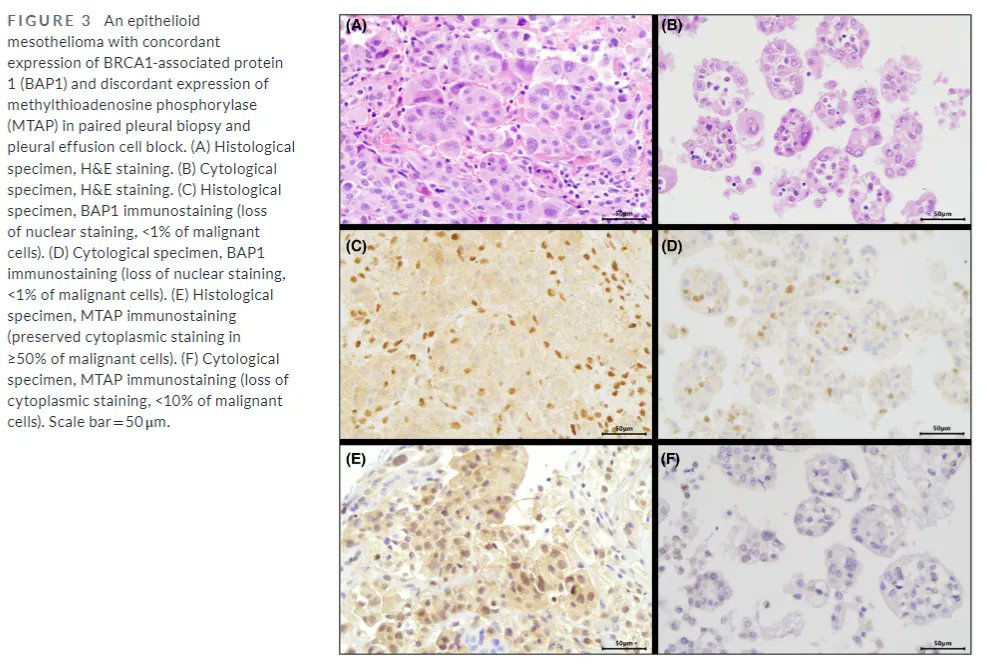 In this #OpenAccess study multiple IHC markers in 59 pleural #mesotheliomas were compared in paired specimens. Biopsies and FFPE pleural effusion cell blocks were concordant in most cases. #pulmpath #CytoHistoCorrelation #CytoJ
buff.ly/3PGb19X