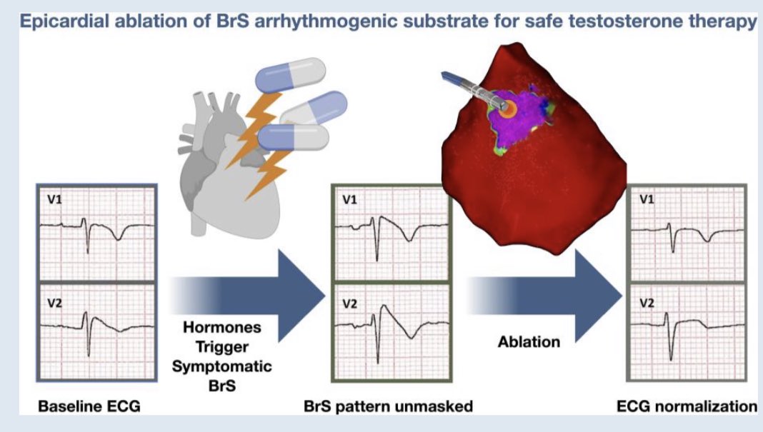 ⚡️⚡️⚡️ Role of epicardial #ablation in symptomatic #Brugada syndrome patients receiving testosterone replacement therapy for hypopituitarism and gender reassignment 📖 doi.org/10.1093/europa… @GiulioConte9 @Dominik_Linz @marcovitoloMD @FraSantoroMD @AndyZhangMD @LuigiDiBiaseMD