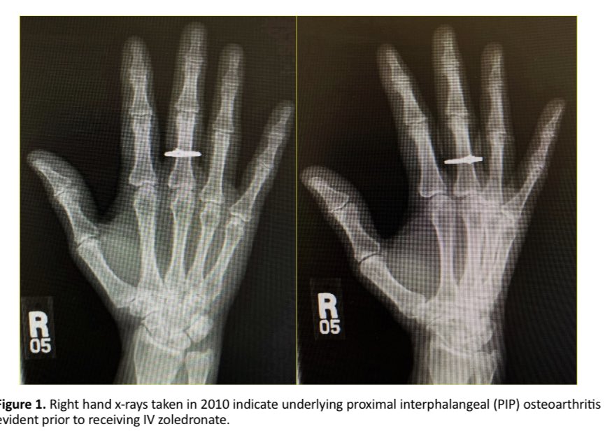 BeyondRheumatol's tweet photo. Polyarthritis following infusion of zoledronic acid: a case study. 

https://t.co/YDwt7BmigP https://t.co/mP8dWdfsi9