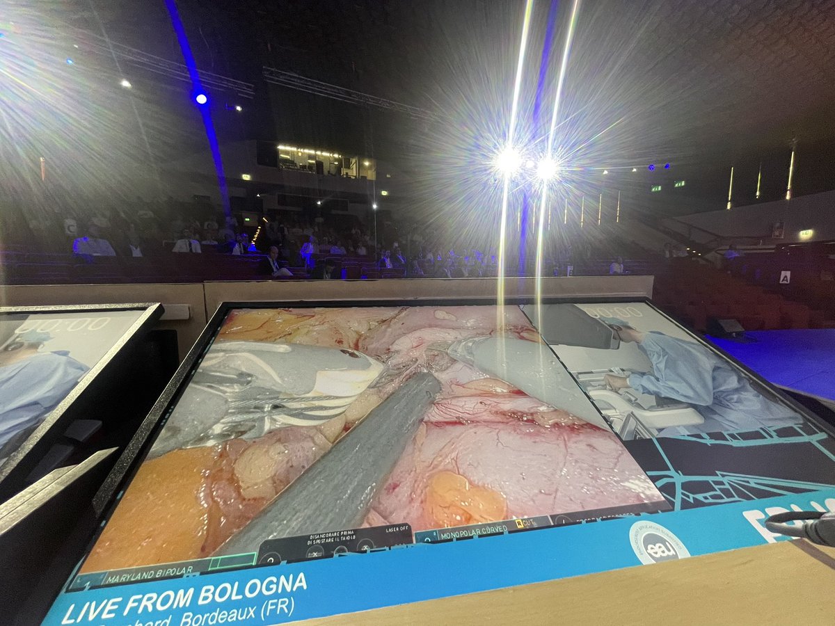 RicBertolo's tweet photo. A real pleasure and honour co-moderating last #livesurgery session with superstar @declangmurphy 🇦🇺

Challenging case of #RAPN by Prof. Bernhard 🇫🇷.

Sone highlights: 
•hilum prepared with careful #vascular #dissection
•#offclamp #enucleation with some arterial vessels clipped
•selective #renorrhaphy during enucleation
•ICG #fluorescence to check the vascularisation of remnant parenchyma 
(enjoy the nice video👇🏼)