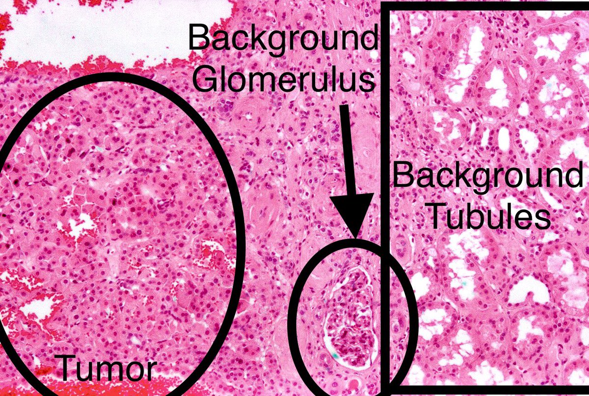Path4People's tweet photo. I am a kidney mass. 
Well circumscribed. 
But have a central +\- stellate scar
I am CD117/CKIT +
Dx?  

#pathagonia #pathx #gux #gupath #urox #urology #medstudentx #pathology #histology #kidney #nephrology https://t.co/CV1gwKGzdS