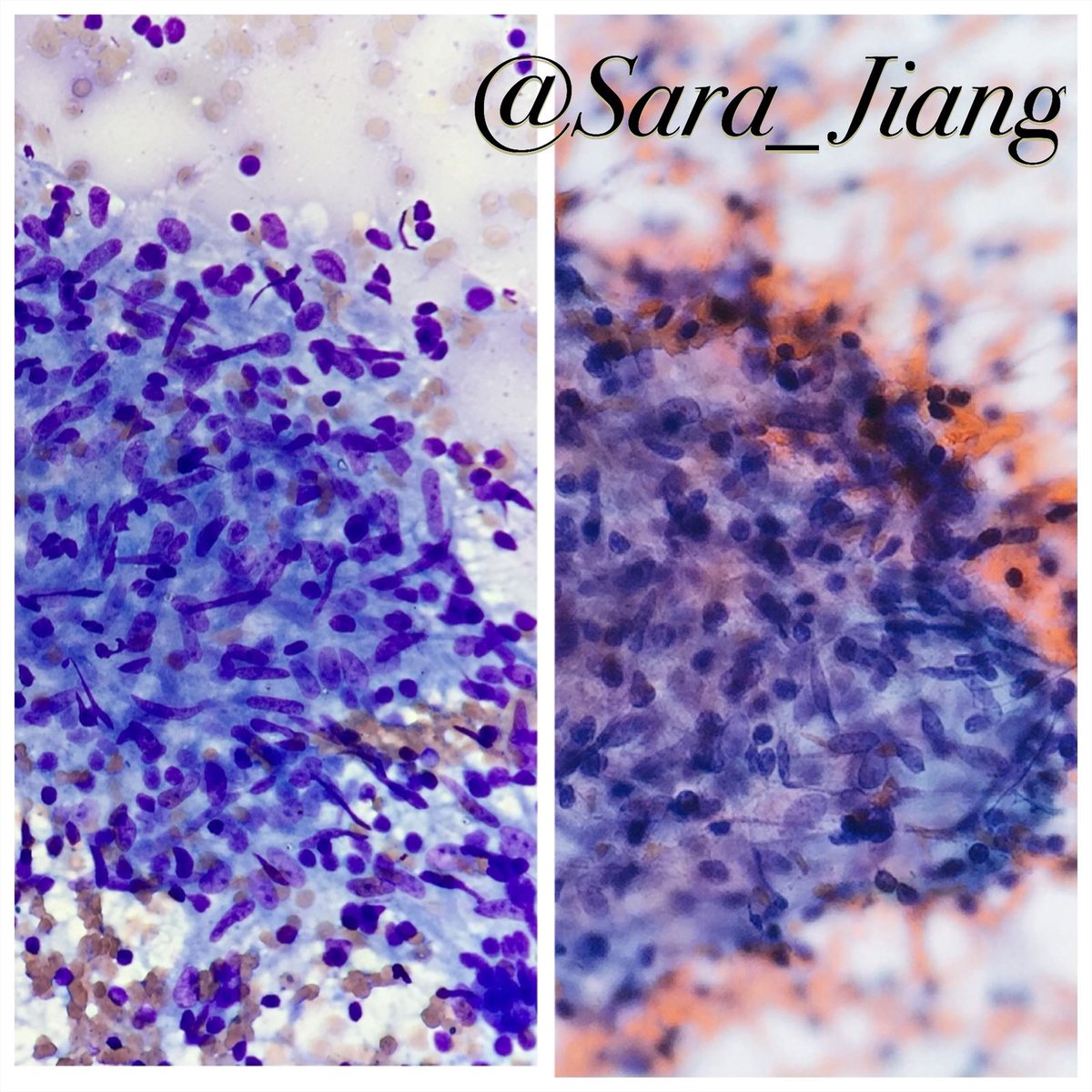 Sara_Jiang's tweet photo. Today's #FNAFriday #DQvsPAP!
#CytoPath of a Granuloma!
💃🏻Epithelioid histiocytes have "footprint" nuclei, leading to a "dance step diagram" appearance in both DQ and Pap!
🤔In US, when you see well-formed granulomas w/out necrosis, think about sarcoidosis! https://t.co/eOPBadXDqt