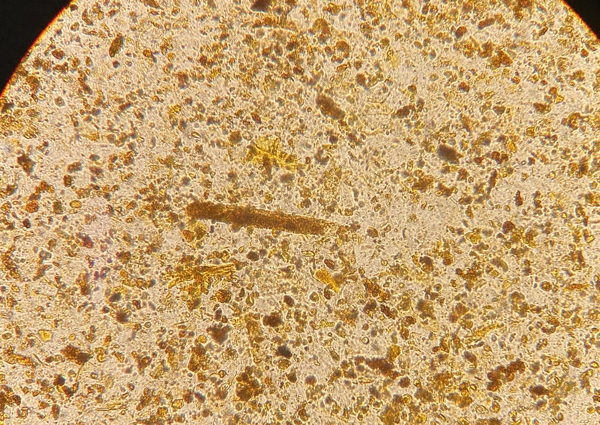 PEPJLHC's tweet photo. 38 yo ♀️ Primary biliary cholangitis, + peritoneal tuberculosis, total bilirubin 50 mg/dl. #UrinarySediment by Internal Medicine fellows shows abundant bilirubin casts.
#InternalMedicineGea
#NefroGea
#NephTwitter https://t.co/73D1s5PMXn