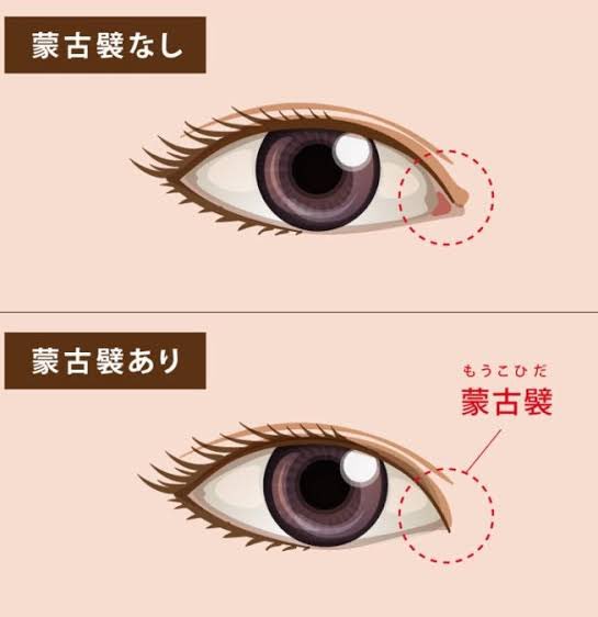 imoco_update's tweet photo. 🔖目頭切開で後悔する人の特徴3選

① 蒙古襞がない
 = 涙丘（ピンクの部分）が見える

★ 離れ目でも蒙古襞がなければ不適応

￼

② 目と目の距離が近い
 = 求心顔

★ 目頭切開すると悪化して地獄

↓↓↓ツリーに続く https://t.co/KnmZrylVAW