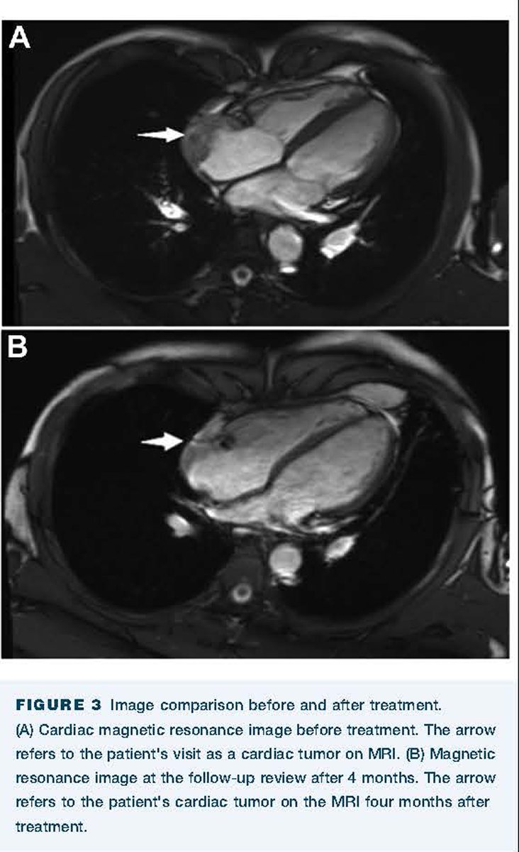 Zhong, Cai, and coauthors present surgical management strategies for a patient with cardiac angiosarcoma with spine destruction as the first symptom. Read more: doi.org/10.1016/j.atss…  #OpenAccess #AnnalsImages