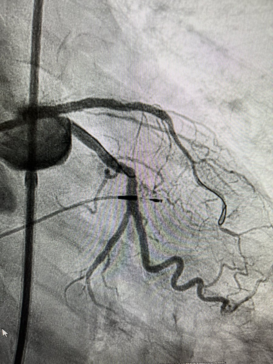 Very active 90 yo with CCS 3 angina and LAD #CTO. LAD opened, angina goes away. Patient was very happy that he got his QoL back, when I saw him in clinic. Sometimes, age is just a number! @UWMedHeart @agtruesdell