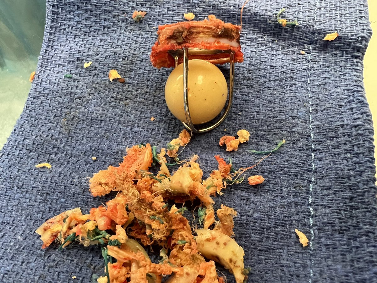 Dr Raymond C Lee MD (@drraycleemd) on Twitter photo A little slice of history during this last case. Never thought I would see one of these. Name that valve <a href="/tomcnguyen/">Tom C. Nguyen, MD</a> <a href="/EcmoNinja/">ECMONinja</a> <a href="/SergeKobsaMD/">Serge S. Kobsa, MD, PhD</a> <a href="/koriannj/">Kori</a> <a href="/UscCardiac/">USC Cardiac</a> <a href="/USCHeartFailure/">USCHeartFailure</a> <a href="/AortaSurg/">Kim de la Cruz, MD FACS FACC FCCP</a> <a href="/PeterDowneyMD/">Peter Downey MD</a> <a href="/LuisCastroMD/">Luis J Castro MD</a> A little slice of history during this last case. Never thought I would see one of these. Name that valve <a href="/tomcnguyen/">Tom C. Nguyen, MD</a> <a href="/EcmoNinja/">ECMONinja</a> <a href="/SergeKobsaMD/">Serge S. Kobsa, MD, PhD</a> <a href="/koriannj/">Kori</a> <a href="/UscCardiac/">USC Cardiac</a> <a href="/USCHeartFailure/">USCHeartFailure</a> <a href="/AortaSurg/">Kim de la Cruz, MD FACS FACC FCCP</a> <a href="/PeterDowneyMD/">Peter Downey MD</a> <a href="/LuisCastroMD/">Luis J Castro MD</a>