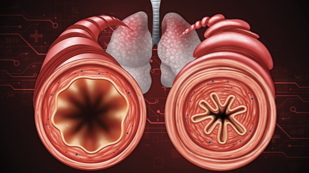 PeerView's tweet image. Join @PeerView in Anaheim, California during #ACAAI23! Expert #Pulmonologists Jonathan Corren, MD, &amp;amp; Mario Castro, MD, will lead a discussion on mucus plugs and their affect on #SevereAsthma. Saturday, November 11th at 8:00 PM PST: bit.ly/SevereAsthma20… #MedTwitter