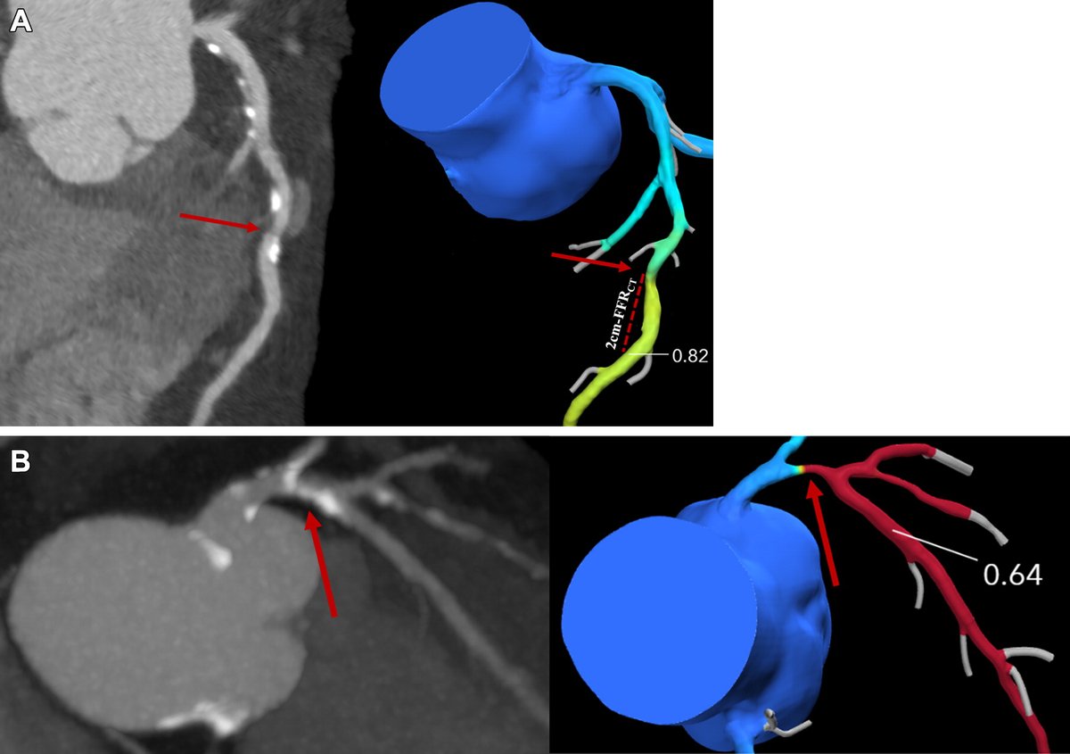 radiology_rsna's tweet photo. Coronary CTA–derived fractional flow reserve value >0.80 was associated with reduced risk of adverse 3-year outcome in participants with stable angina and in those with high coronary artery calcium score. @KTaekker https://t.co/BkpJDxBUY6 https://t.co/oIDo0xp7yC