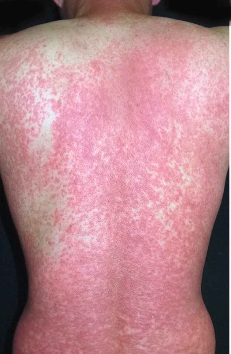 drtimothyli's tweet photo. This patient has spondylodiscitis
He developed generalized rash and recurrence of fever after 4 weeks of antibiotic
Blood tests showed elevated WBC and impaired liver function

Diagnosis?
Can you name a common culprit? https://t.co/dlkqDloK4t