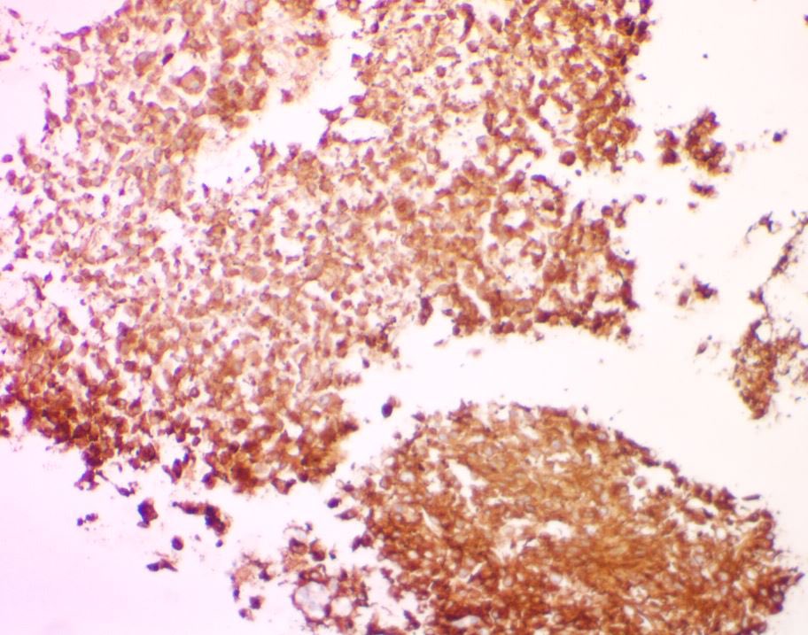 Metastatic GIST to an abdominal lymph node-
With both epithelioid and spindle cell features. Positive for DOG1, CD34 and CD117(shown here). 
#pathtwitter #cytology #surgpath #path <a href="/kkuanMD/">Kevin Kuan</a>