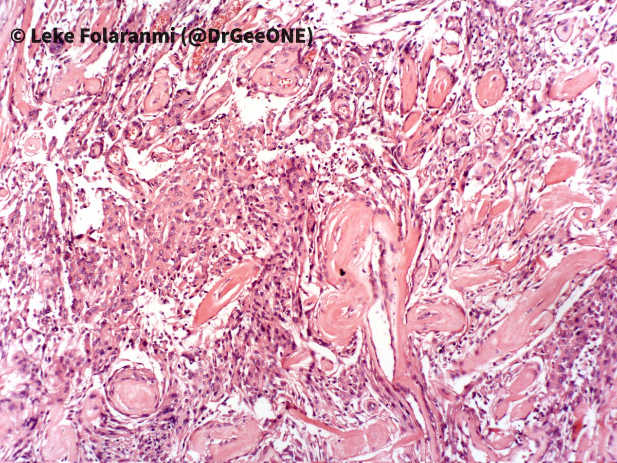 DrGeeONE's tweet photo. Update: 
Meningioma
#CNSpath #Neuropath
#PathTwitter #PathX https://t.co/1lPwJsKqT0