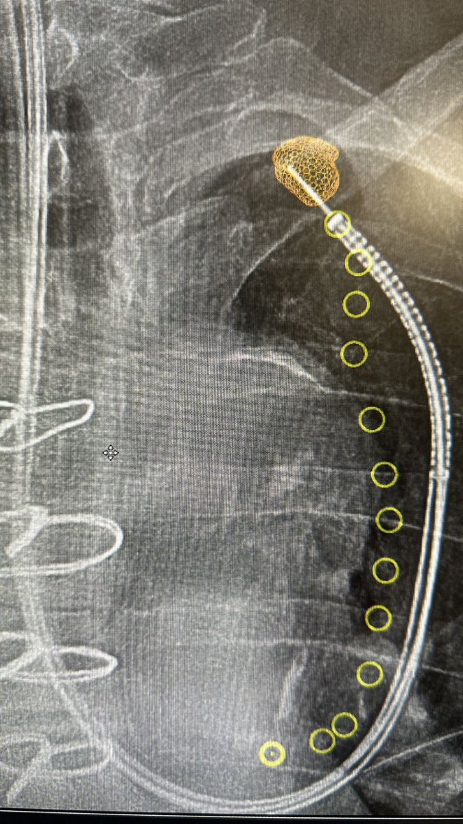 ahalraiyes's tweet photo. The beauty of real-time images 
@IntuitiveSurg #IonbyIntuitive @PhilipsHealth #ConeBeam https://t.co/VGsrUIldDn