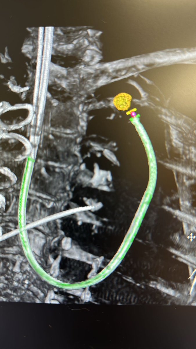 ahalraiyes's tweet photo. The beauty of real-time images 
@IntuitiveSurg #IonbyIntuitive @PhilipsHealth #ConeBeam https://t.co/VGsrUIldDn