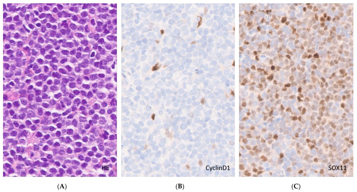 How to Diagnose and Treat CD5-Positive Lymphomas Involving the Spleen
mdpi.com/1354422
#Bcelllymphoma #lymphoma #immunophenotype #cancer #oncology #Hematology