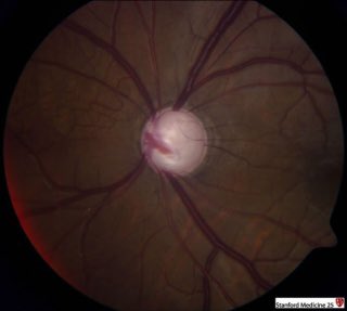 AnaMMartinezEs1's tweet image. I used to review those at Bascom Palmer Eye Institute… one time I won an insurance appeal favoring the University versus a patient attorney, we recovered $125,000 in the claim. @bascompalmereye @univmiami #fundoscopy #revenuerecovery