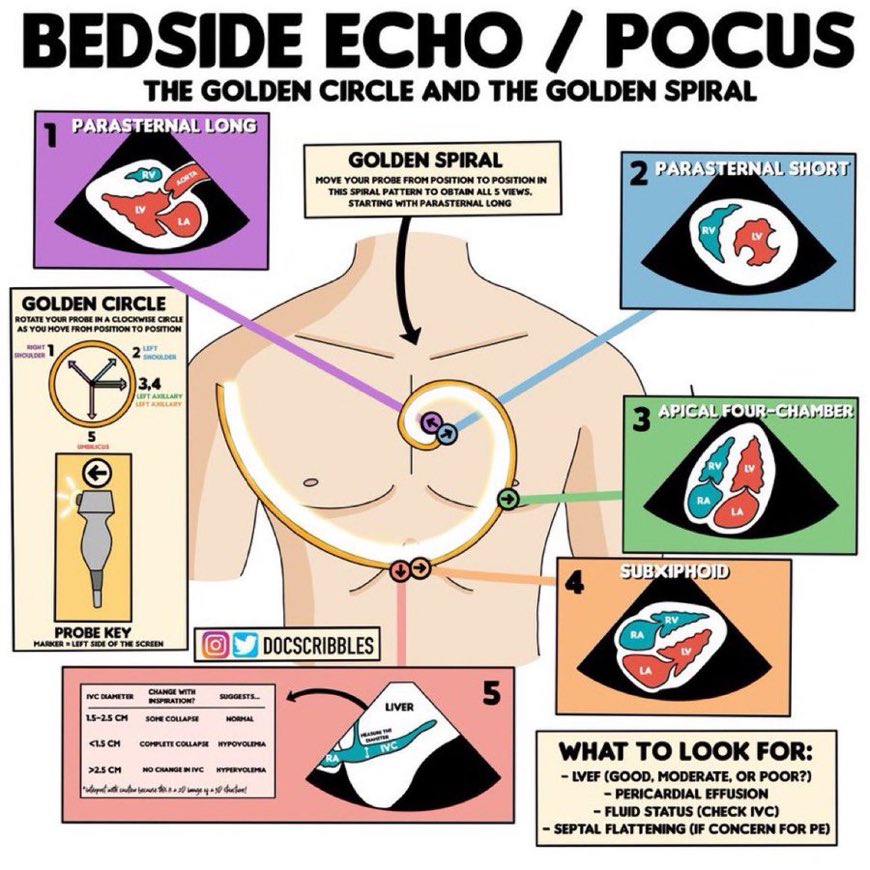🙋‍♂️ Best bedside #POCUS &amp; Echo summary I have seen!
#MedEd #MedTwitter #FOAMcc

Thanks to <a href="/DocScribbles/">Cathy Cichon</a> for this amazing medical art!