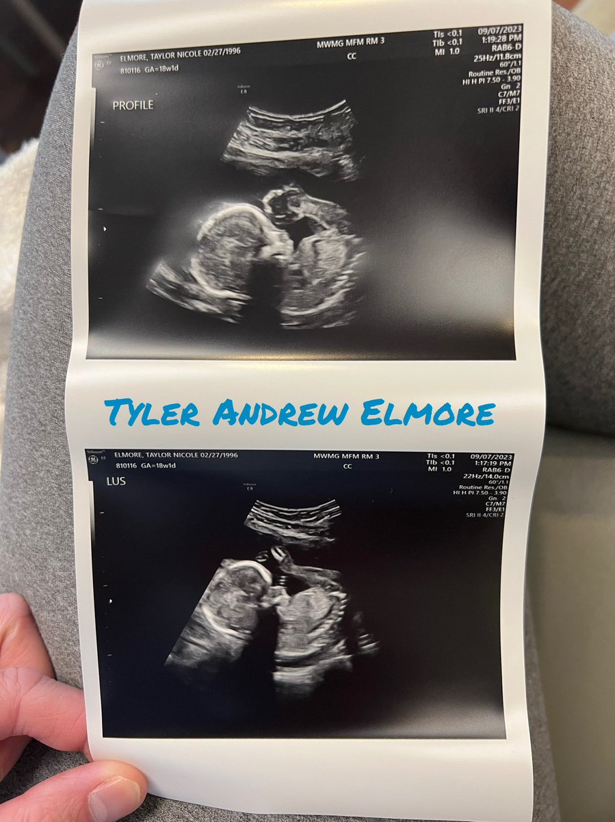 TaylorElmore26's tweet image. Had my #AnatomyScan at 18w1d pregnant with Tyler Andrew ! 💙👶🏼
#September7th2023 #DueFebruary2024 🤰🏼