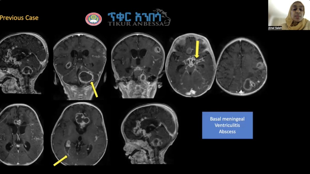 spinacademics's tweet image. Spin 2023 - Day 2 
Infections module kicks of with Bacterial infection... wonderful spectrum of cases with a clear  clinico-rad approach expertly taught to us by  @AmalSalehNour 
#SPIN2023