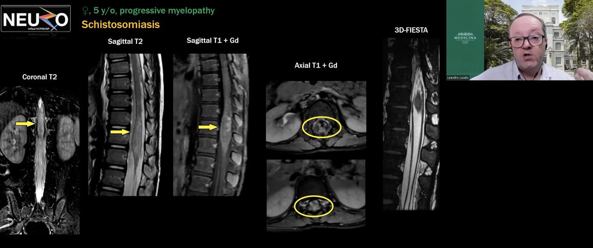 spinacademics's tweet image. #SPIN2023
The ever amazing and subject matter expert @LucatoLeandro teaching us the ins and outs of parasitic disease..
#pedineueorad 🌟