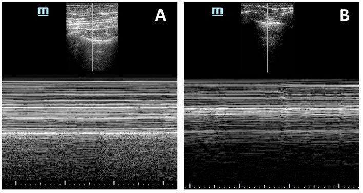Ali_rhmtMD's tweet photo. @IM_Crit_ The lung point is the only sign that confirms pneumothorax, with very high specificity.Anterior pulmonary window (M mode). A) beach sign b) code bar sing https://t.co/0oq1NbRMpH