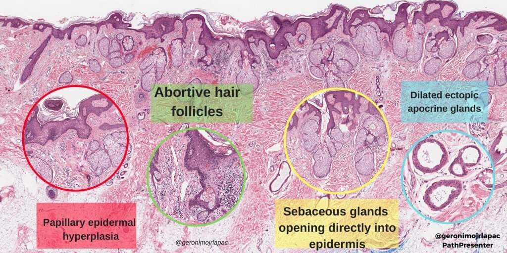 A nice example of Nevus sebaceus of Jadassohn. #dermpath #pathology