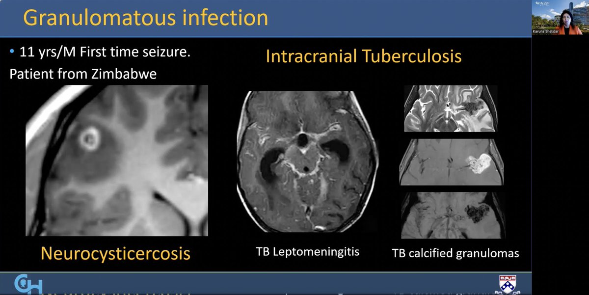 spinacademics's tweet image. Seizures, one of the most common and devastating symptoms in a child.
Imaging manifestaions in a child with acute seizures expertly taught to us by our SAC member @KShekdarMD
Epilepsy noon session in full flow at #SPIN2023 
#pedineurorad #epilepsy