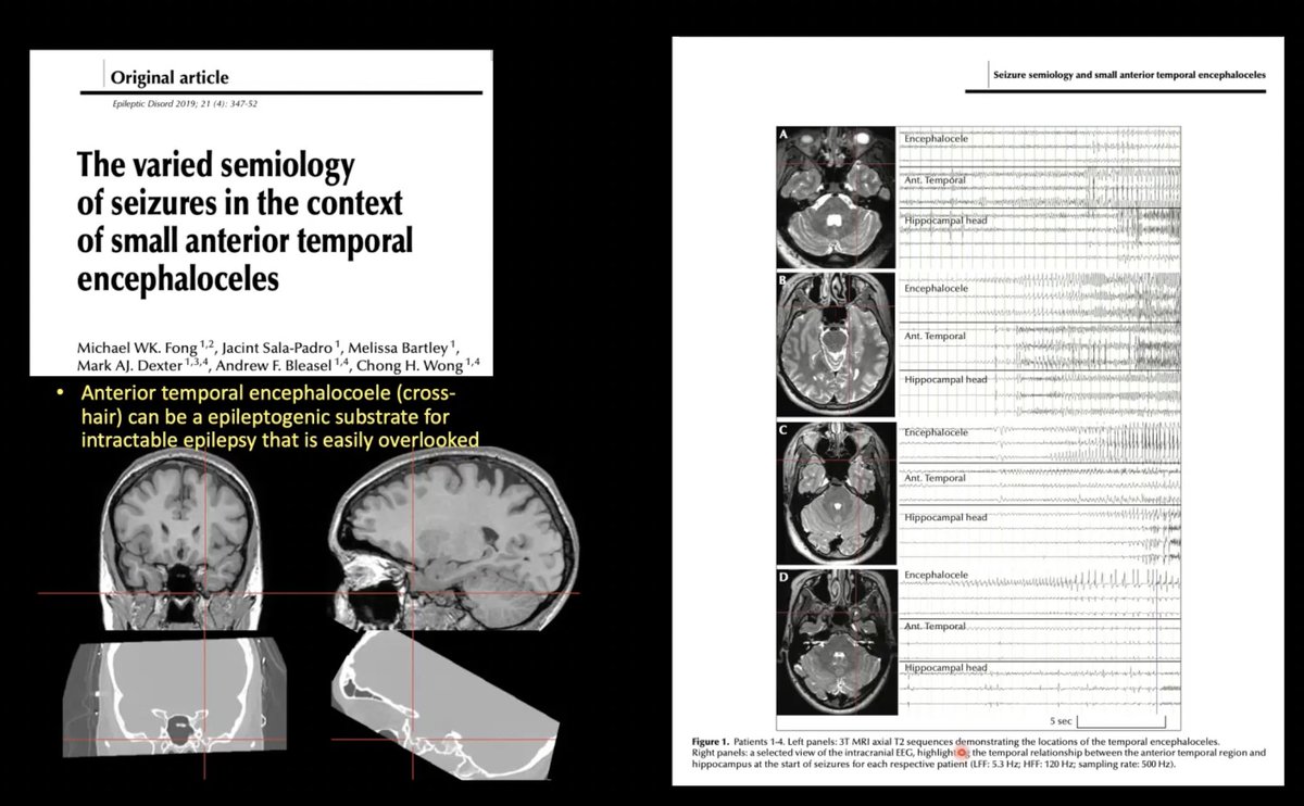 spinacademics's tweet image. Always great to have an Expert epiletplogist,
Dr Deepak Gill from @westmeadkids teach us the clinical and management aspects of Epilepsy substrates.. 
#SPIN2023 
#epilepsy