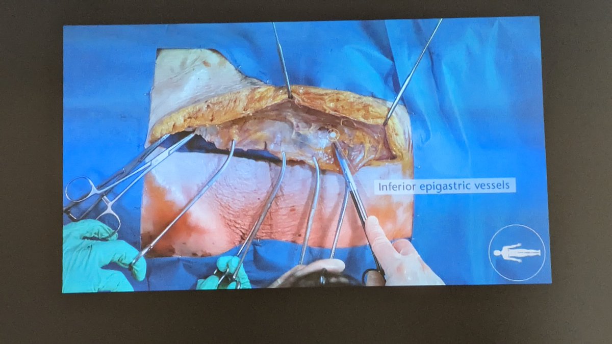 The Dukes' Club (@dukes_club) on Twitter photo An incredibly informative talk by Mr Duncan Scrimgeour <a href="/dsgscrimgeour/">Duncan Scrimgeour</a> on Abdominal Wall Reconstruction. 🤓📑✍️ for your everyday practice and FRCS! #DukesWeekend2023
Exclusive Sponsor: @Ethicon
Dial in from home: bit.ly/Dukes23virtual An incredibly informative talk by Mr Duncan Scrimgeour <a href="/dsgscrimgeour/">Duncan Scrimgeour</a> on Abdominal Wall Reconstruction. 🤓📑✍️ for your everyday practice and FRCS! #DukesWeekend2023
Exclusive Sponsor: @Ethicon
Dial in from home: bit.ly/Dukes23virtual
